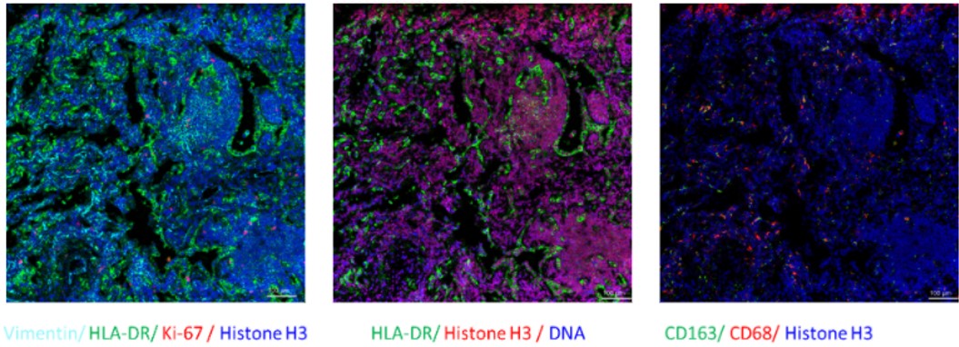 Fig. Representative mass cytometry image of a lung cancer patient’s tissue section showing the overlay of multiple markers. Selected markers are represented by pseudo-colored raw ion images. 